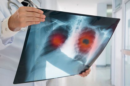 cada a&ntilde;o se detectan m&aacute;s de 129.000 nuevos casos de c&aacute;ncer en el pa&iacute;s y 60.000 argentinos mueren por esta enfermedad (Shutterstock)
